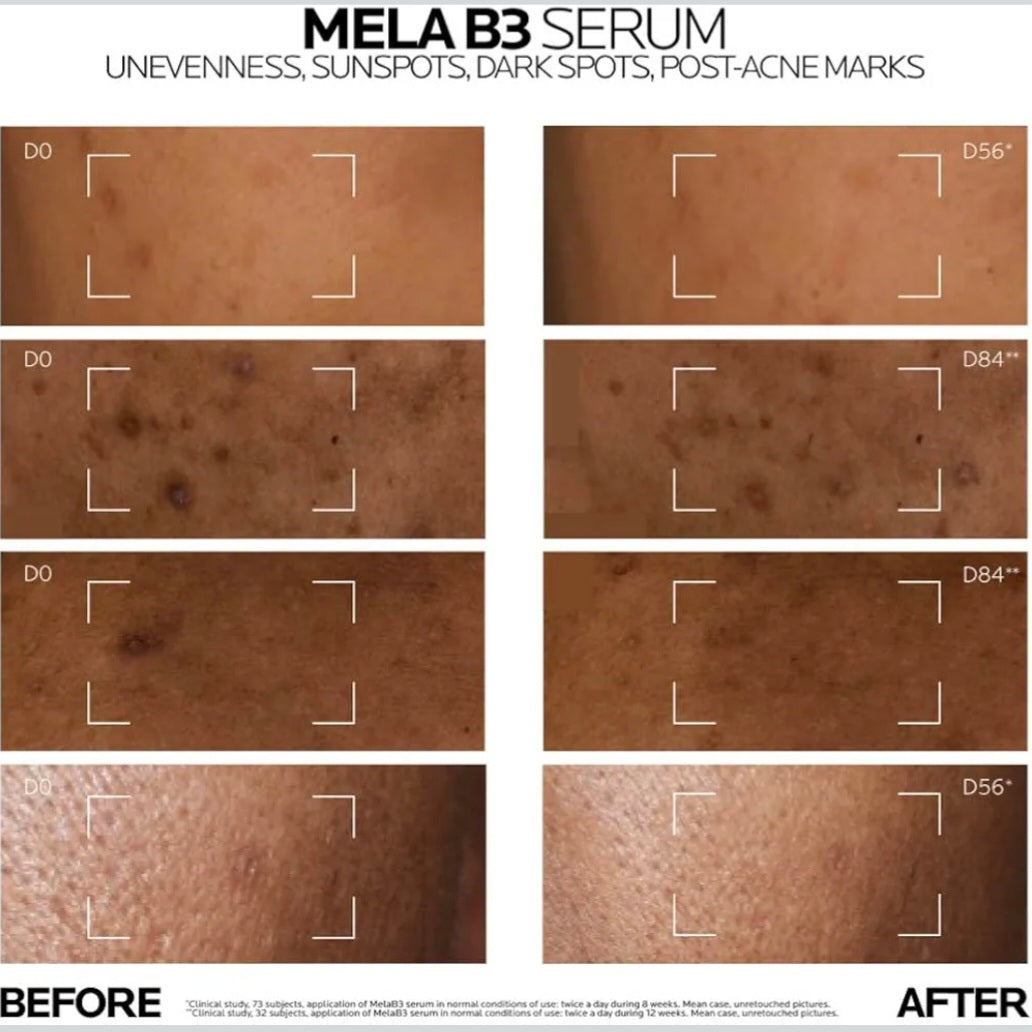 La Roche-Posay MelaB3 Serum: Intense Anti-dark Spot Serum for Hyperpigmentation 30ml